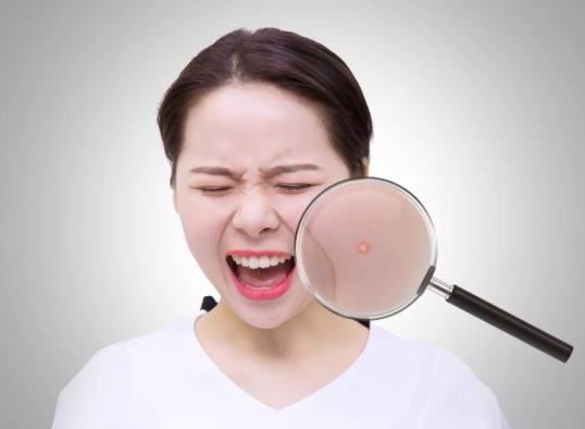 挤痘痘颅内感染会死吗?挤痘痘颅内感染多久能看出来?