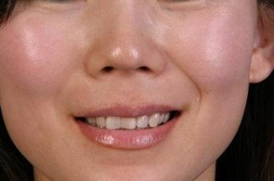 女生法令纹怎么消除 多种方法供你选择