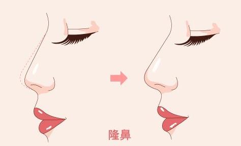什么样的人适合隆鼻 注射玻尿酸隆鼻该注意什么