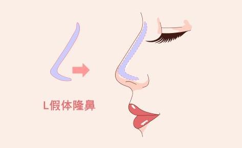 什么样的人适合隆鼻 注射玻尿酸隆鼻该注意什么