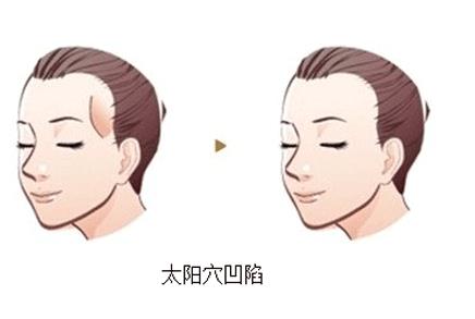 如何提高丰颞术的自体脂肪成活率