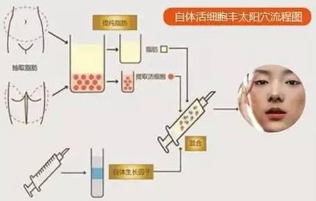 如何提高丰颞术的自体脂肪成活率