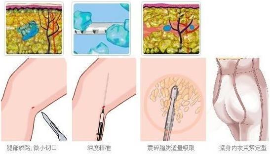 南京韩辰吸脂术 力求整形美无痕