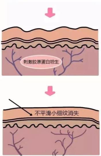 北京伊美尔紫竹医院:光子嫩肤多久做一次