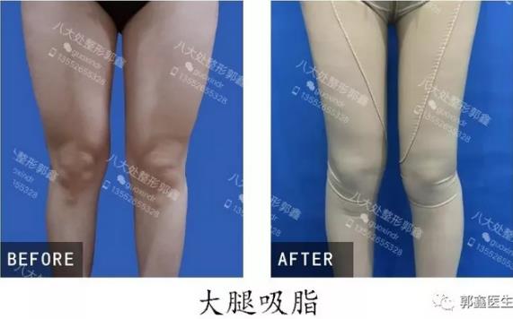 八大处整形郭鑫小腿吸脂吸脂减肥瘦瘦腿斤跑步3v小腿公里多少图片