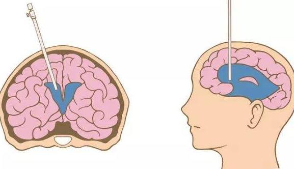 脑积水的治疗方式有哪些?脑积水治疗后需要补充哪些营养?