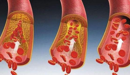 糖尿病性肾病的症状有哪些?糖尿病性肾病需要做哪些检查?