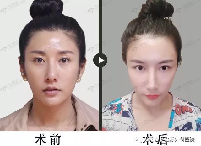 根本问题其实在于脸部轮廓过于圆润, 且五官扁平不够立体!