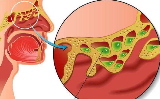 引起鼻甲肥大的病因有哪些?鼻甲肥大需要做哪些检查?