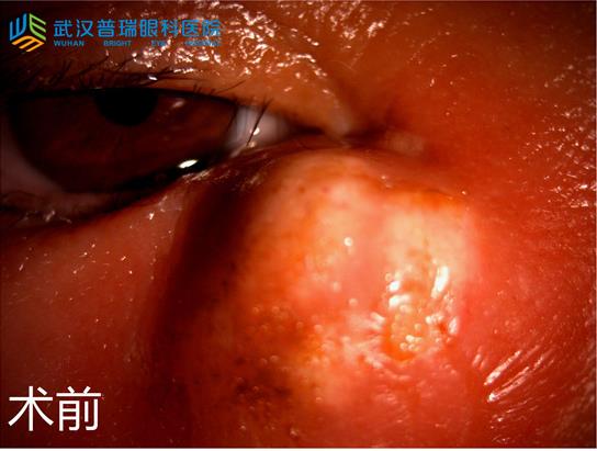 眼角疼还胀起脓包 慢性泪囊炎发作吓坏六旬阿姨