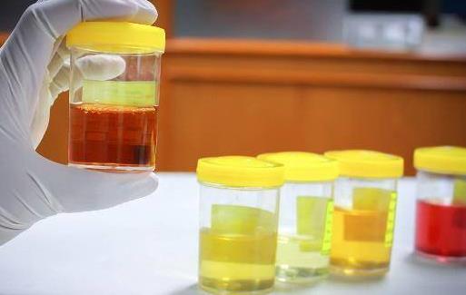 尿液发白是糖尿病吗?出现白色尿液的原因有哪些?