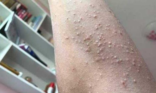 患疥疮的原因有哪些?疥疮有哪些并发症?