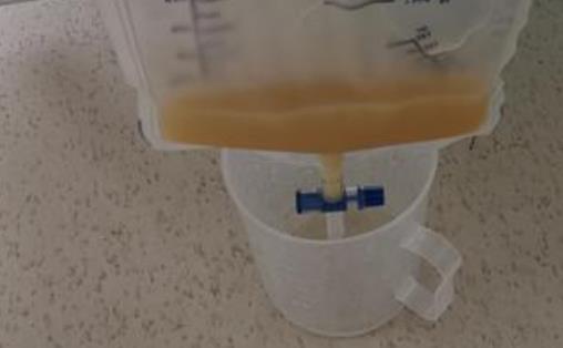 健康养生 健康常识乳糜尿是从肠道吸收的乳糜液脂肪皂化后的液体)不能