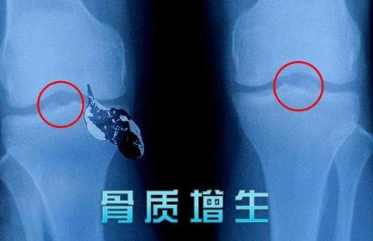 骨质增生的症状有哪些?骨质增生需要做手术吗