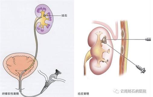 云南结石病医院肾结石患者:肾结石症状腰疼就像一把刀子来回绞动