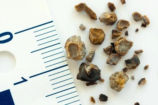 广州治疗肾结石比较好的医院在哪里?广州治疗肾结石哪个医生好?
