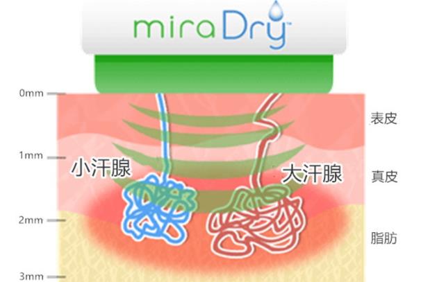圣心美容高须淳司医生解析:MiraDry清新微波治疗腋臭多汗的原理和效果
