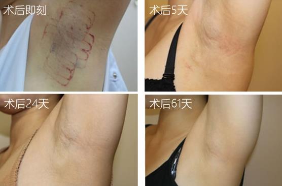 圣心美容高须淳司医生解析:MiraDry清新微波治疗腋臭多汗的原理和效果
