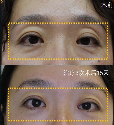 天津联合丽格高盛川院长|有泪沟别着急填充,必须针对性治疗!