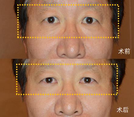 天津联合丽格高盛川院长|有泪沟别着急填充,必须针对性治疗!