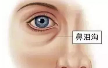 天津联合丽格高盛川院长|有泪沟别着急填充,必须针对性治疗!