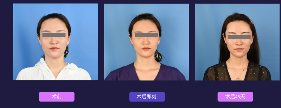 宁波艺星整形医院:7D黄金超声炮,深层抗衰,一次抵三次热玛吉!