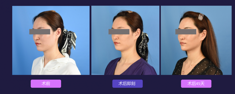 宁波艺星整形医院:7D黄金超声炮,深层抗衰,一次抵三次热玛吉!