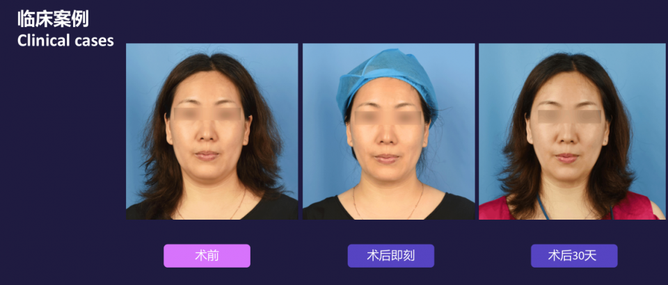 宁波艺星整形医院:7D黄金超声炮,深层抗衰,一次抵三次热玛吉!