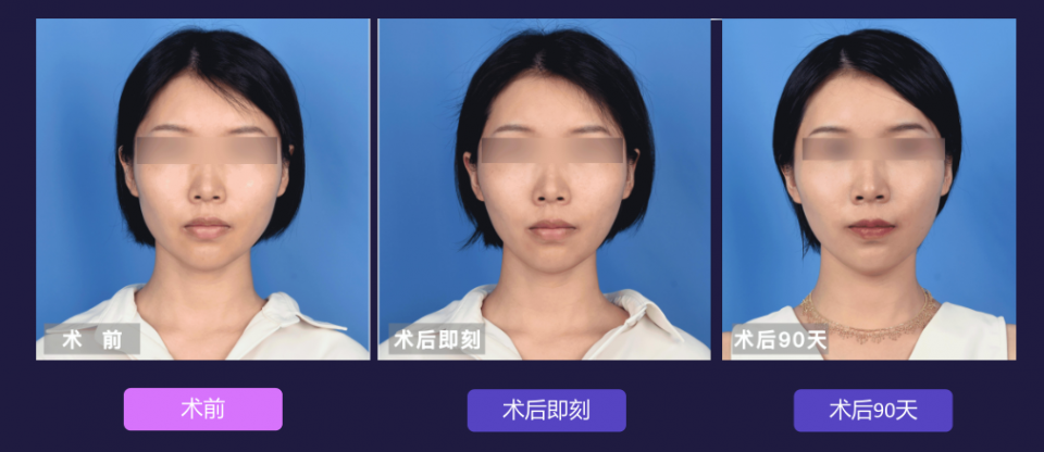 宁波艺星整形医院:7D黄金超声炮,深层抗衰,一次抵三次热玛吉!