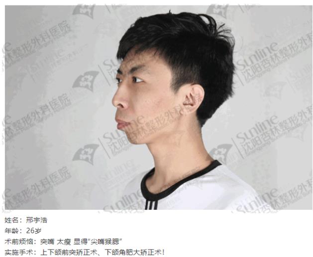 沈阳杏林整形外科医院说说：下颌后缩怎么办