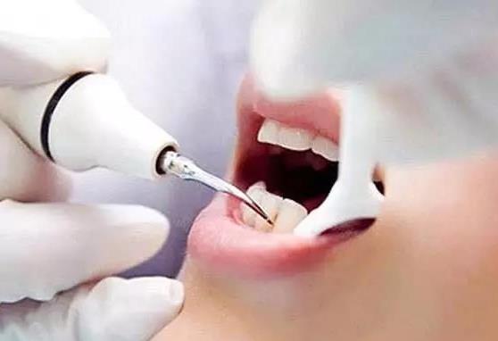 牙结石不洗牙有别的方法吗?洗牙结石一次能完全洗干净吗