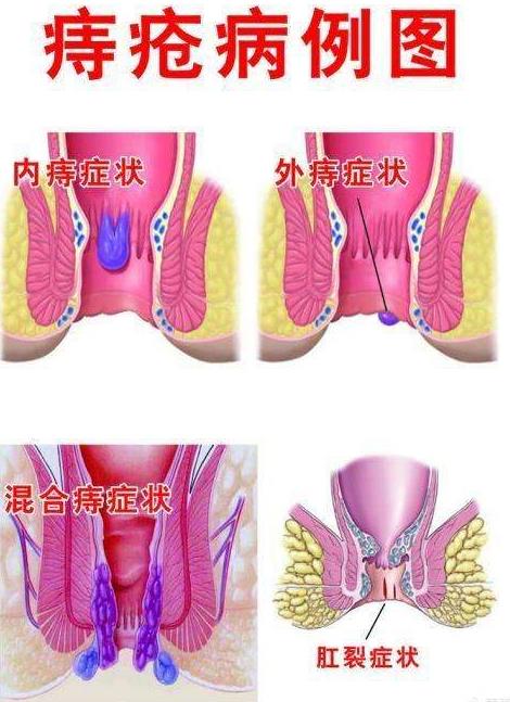 痔疮长什么样子在哪个位置图片(内痔外痔混合痔肉球脱出症状对照图片)