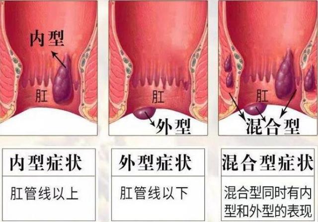 痔疮长什么样子在哪个位置图片(内痔外痔混合痔肉球脱出症状对照图片)