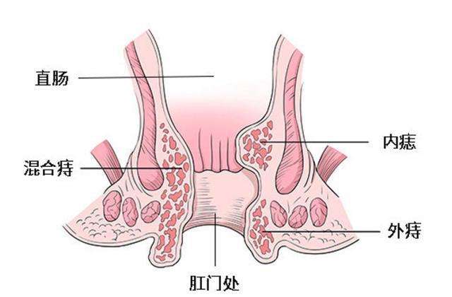 痔疮长什么样子在哪个位置图片(内痔外痔混合痔肉球脱出症状对照图片)