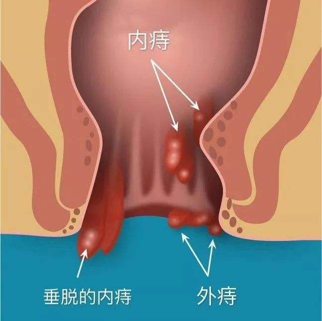 痔疮长什么样子在哪个位置图片(内痔外痔混合痔肉球脱出症状对照图片)