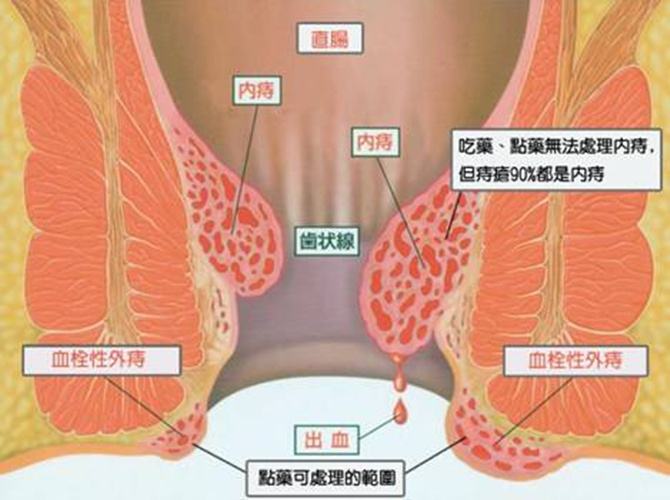 痔疮长什么样子在哪个位置图片(内痔外痔混合痔肉球脱出症状对照图片)