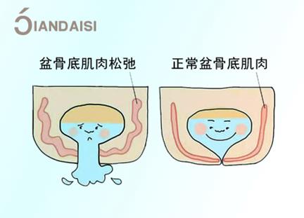 产后漏尿严重怎么治疗？介绍2个经验