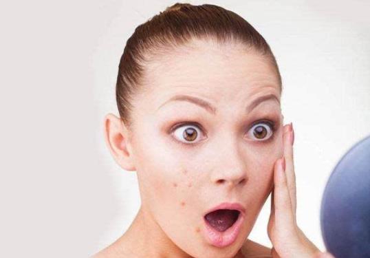 痘痘能不能挤?要不要挤?正确挤痘痘方法及挤痘痘的后续护理