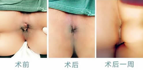 女性痔疮真人实拍图片 网上曝光的7个小偏方有效治痔疮 女性痔疮真人实拍图片:网上曝光的7个小偏方有效治痔疮