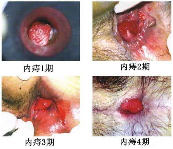 女性痔疮真人实拍图片 网上曝光的7个小偏方有效治痔疮 女性痔疮真人实拍图片:网上曝光的7个小偏方有效治痔疮