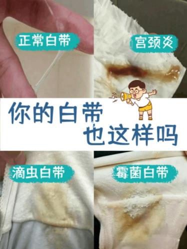 正常白带是什么样子的真实图片 女性下面白带异常各种症状图片大全