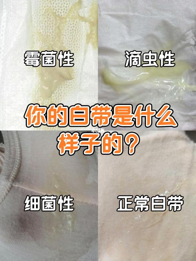 正常白带是什么样子的真实图片 女性下面白带异常各种症状图片大全(4)