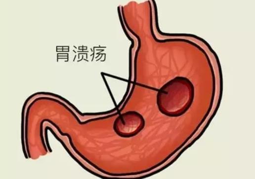 胃溃疡的症状是什么?胃溃疡不能吃什么
