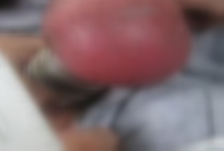 (男子嘿咻九钢环套蛋 睾丸肿如橘子险绝后.jpg