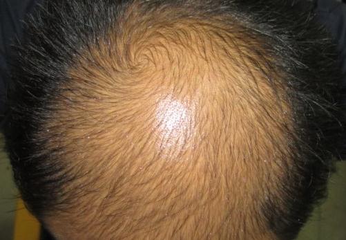 所谓“养肾补肾”防脱发,风牛马不相及