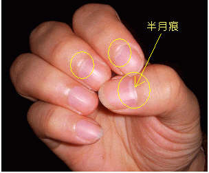 指甲上的半月痕你懂多少？指甲半月痕与健康吉凶