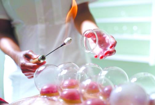 拔火罐能减肥吗？拔火罐减肥有用吗