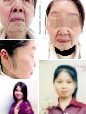 85年少妇分娩后变老太，获得性面部皮肤衰老症怪病无药可医，早婚早育生第二胎