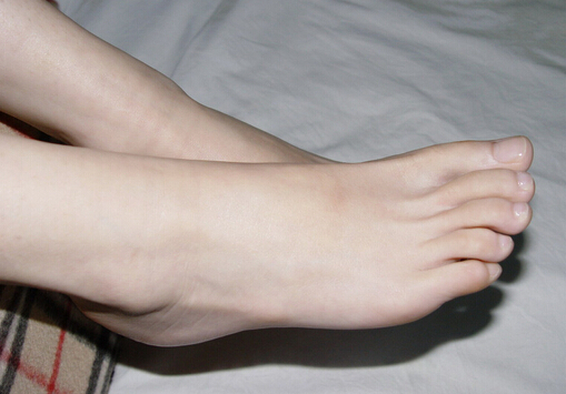 脚上长鸡眼怎么办?如何预防脚上长鸡眼