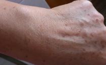 充足睡眠预防老年斑 吃什么可以祛除老年斑？